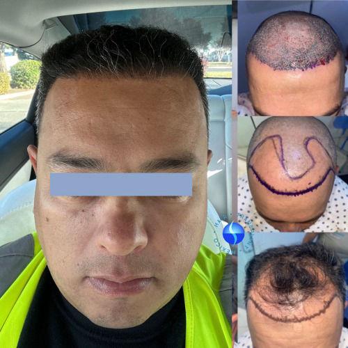 before  and  After 