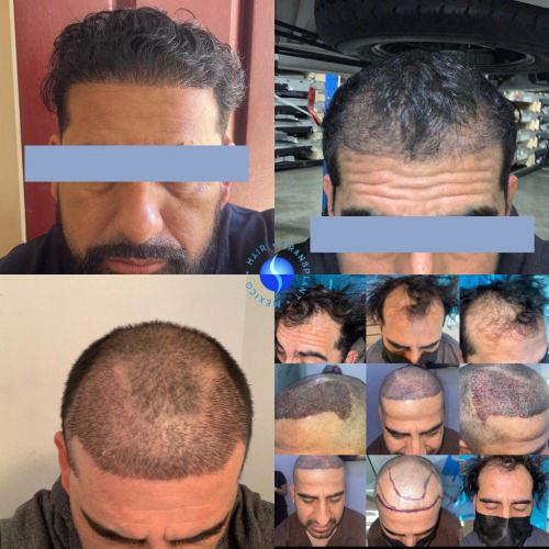 before  and  After 