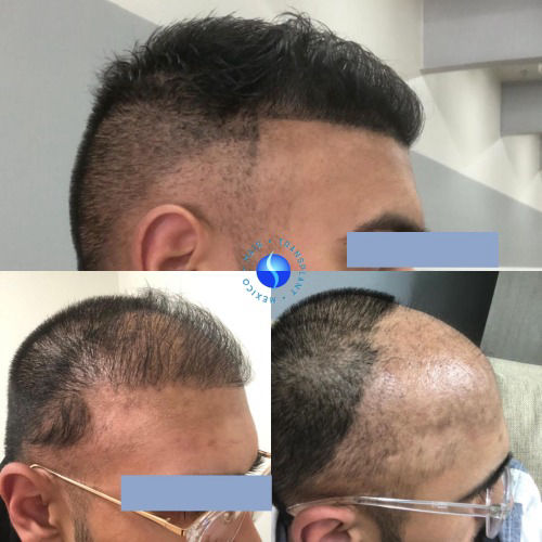 before  and  After 