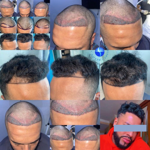 before  and  After 