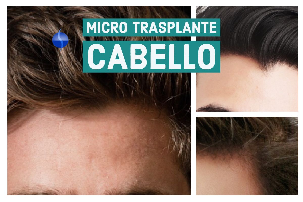 trasplante cabello